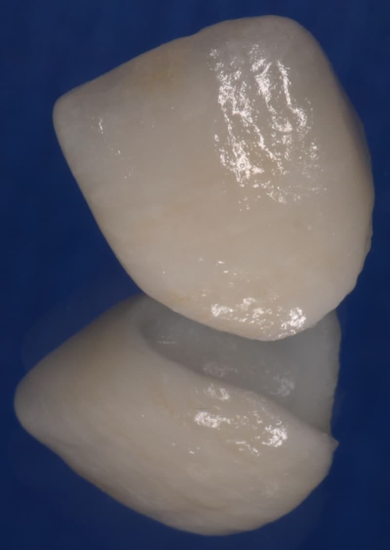 A white tooth with a reflection on a blue surface in Dentevita's prosthodontics.