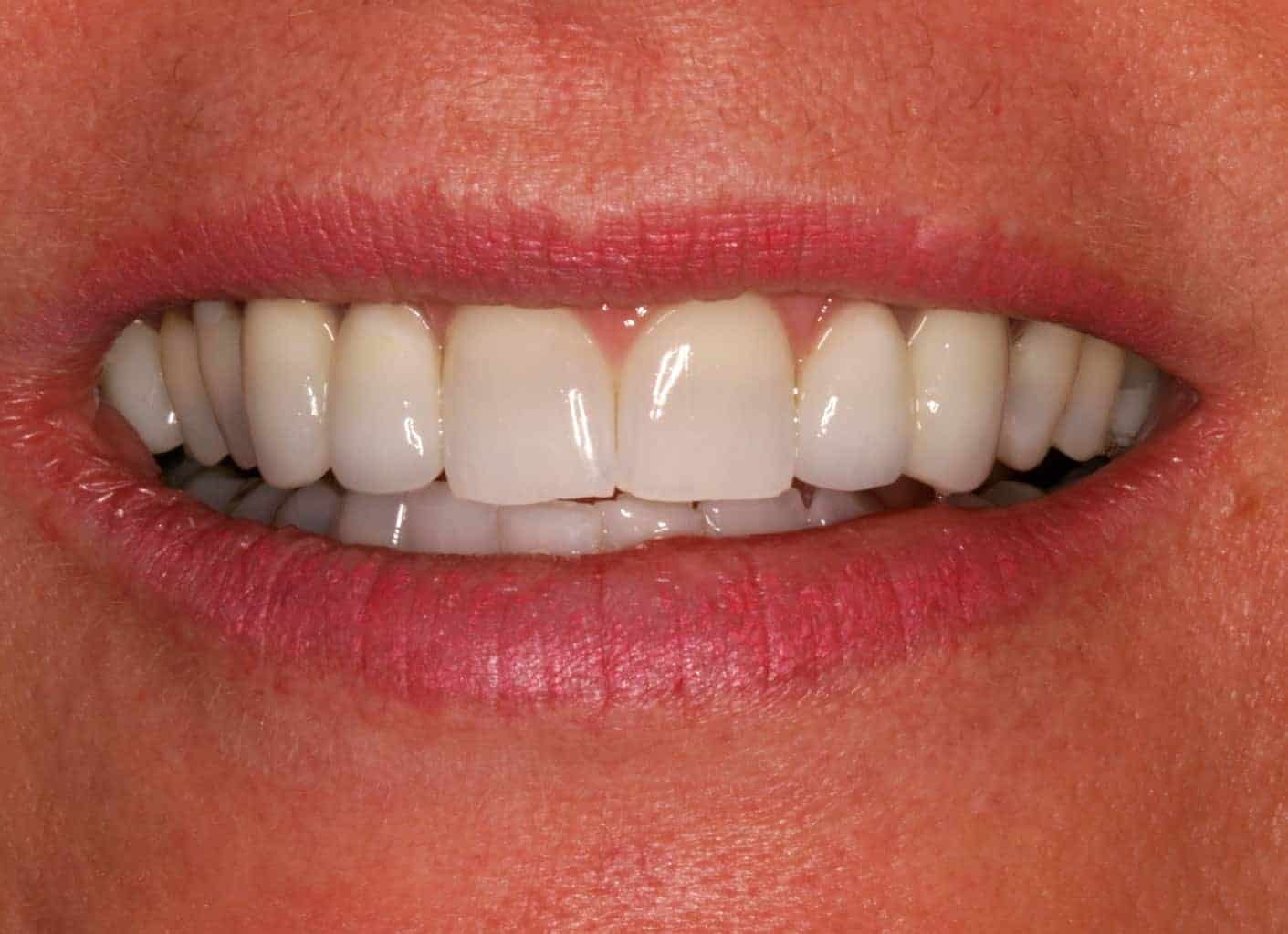 A close up of a woman's teeth with white fillings, featuring dentevita.
