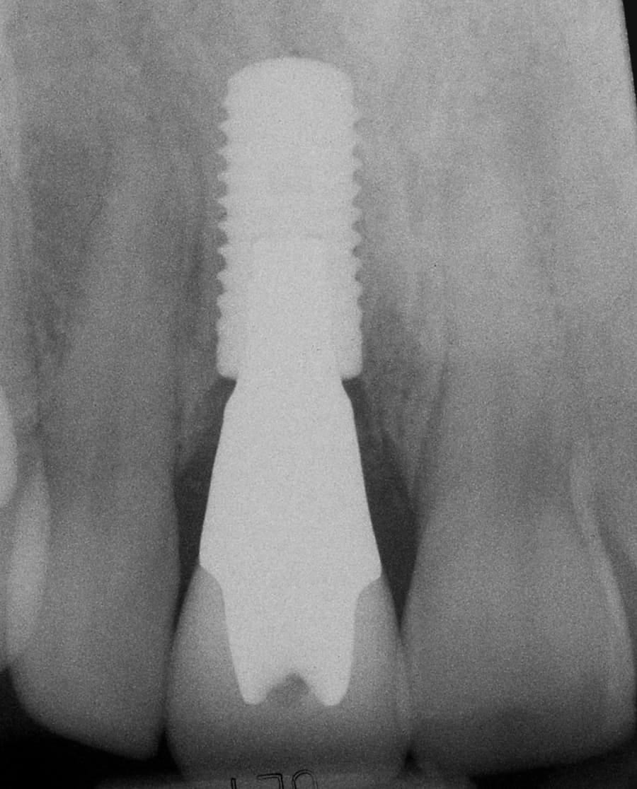 An x-ray of a tooth with a dental implant performed by Aldo Leopardi at Dentevita in Denver.
