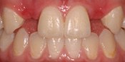 missing_incisors1