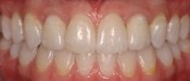 Partial Tooth Replacement Denver Partial Tooth Replacement Denver