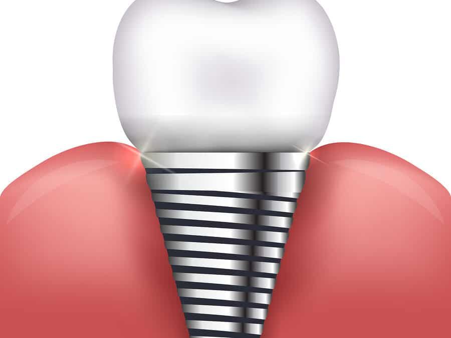 Single Tooth Replacement Makes Sense for a Greater Smile