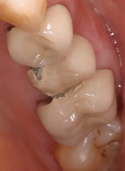 Partial Dentures Trauma Decay Tooth removal Dental Denver Partial Dentures Trauma Decay Tooth removal Dental Denver