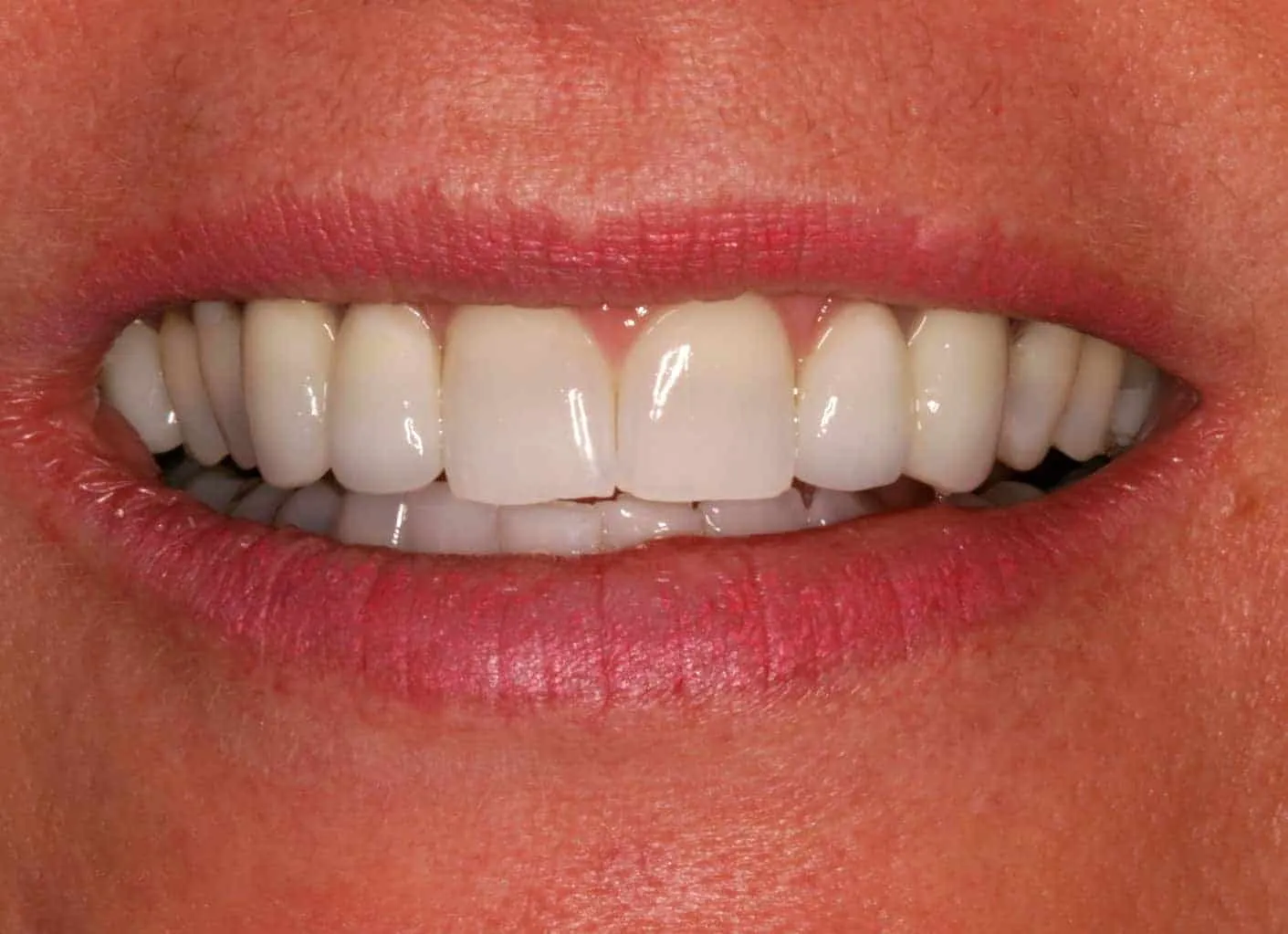 A close up of a woman's teeth with white fillings, featuring dentevita.
