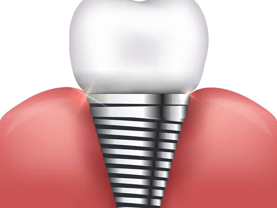 Single Tooth Replacement Makes Sense for a Greater Smile